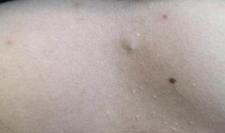 瘢痕疙瘩吧 瘢痕疙瘩吧